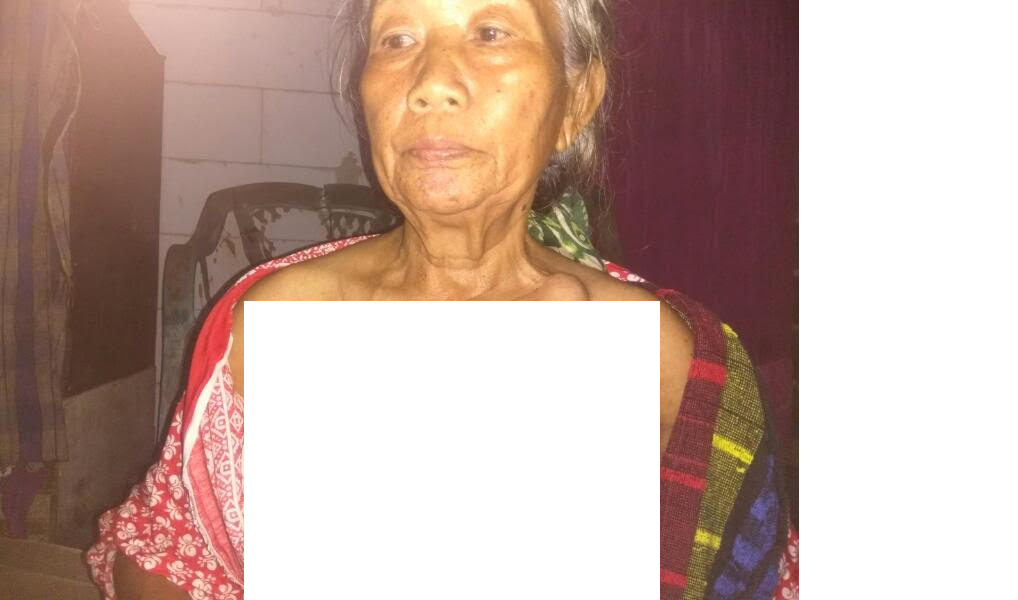 4 Tahun Mengidap Kanker Payudara, Warga Miskin Ini Belum Dapat Perhatian Pemda 4 Tahun Mengidap Kanker Payudara, Warga Miskin Ini Belum Dapat Perhatian Pemda