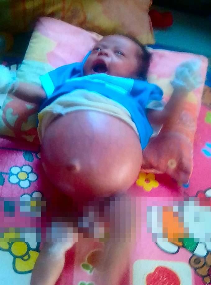 Butuh Bantuan, Besok Bayi Rhamdan Dioperasi Butuh Bantuan, Besok Bayi Rhamdan Dioperasi