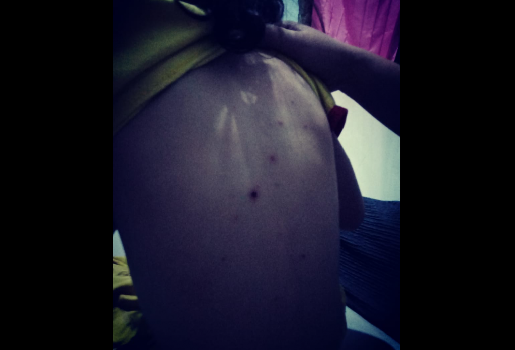 Warga Terserang Gatal-gatal Akibat Limbah Air Sampah TPA Kopiluhur