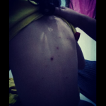 Warga Terserang Gatal-gatal Akibat Limbah Air Sampah TPA Kopiluhur