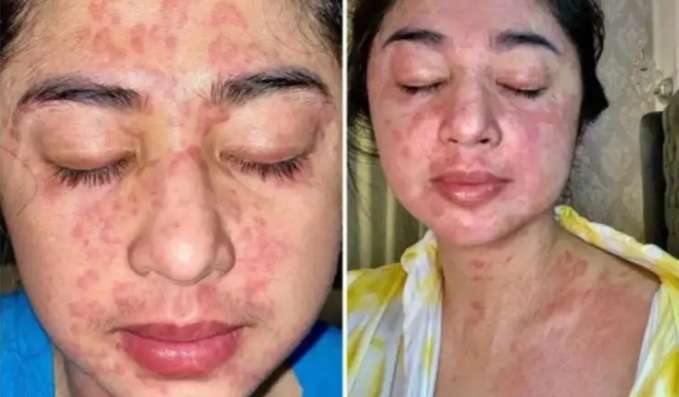 Sembuh Dari Covid, Kulit Dewi Perssik Jadi Begini